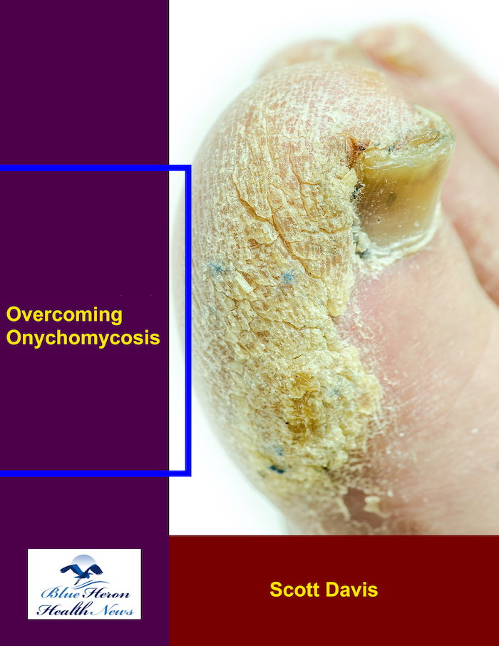 Overcoming Onychomycosis eBook PDF