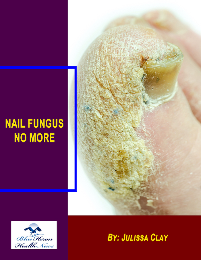 (PDF) Nail Fungus No More Book By Julissa Clay