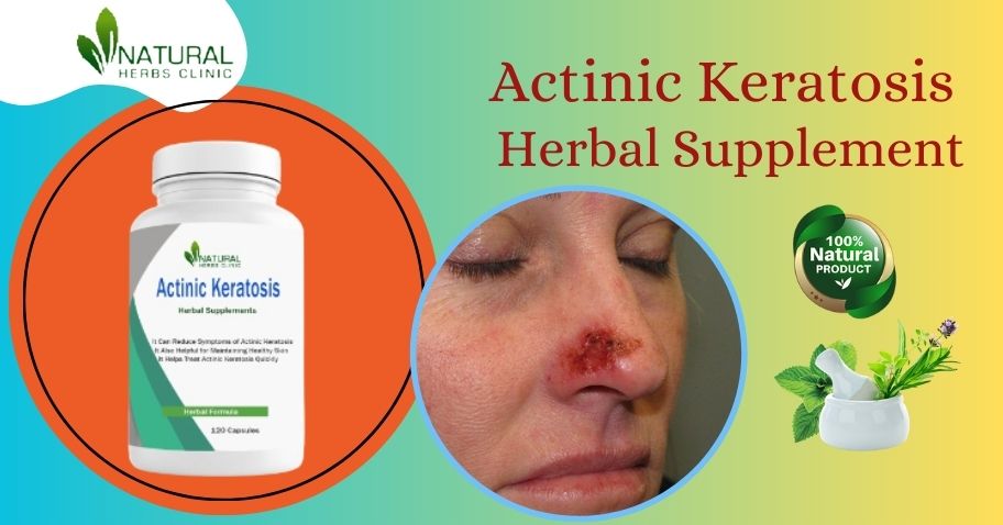 Herbal Supplement for Actinic Keratosis Natural Treatment