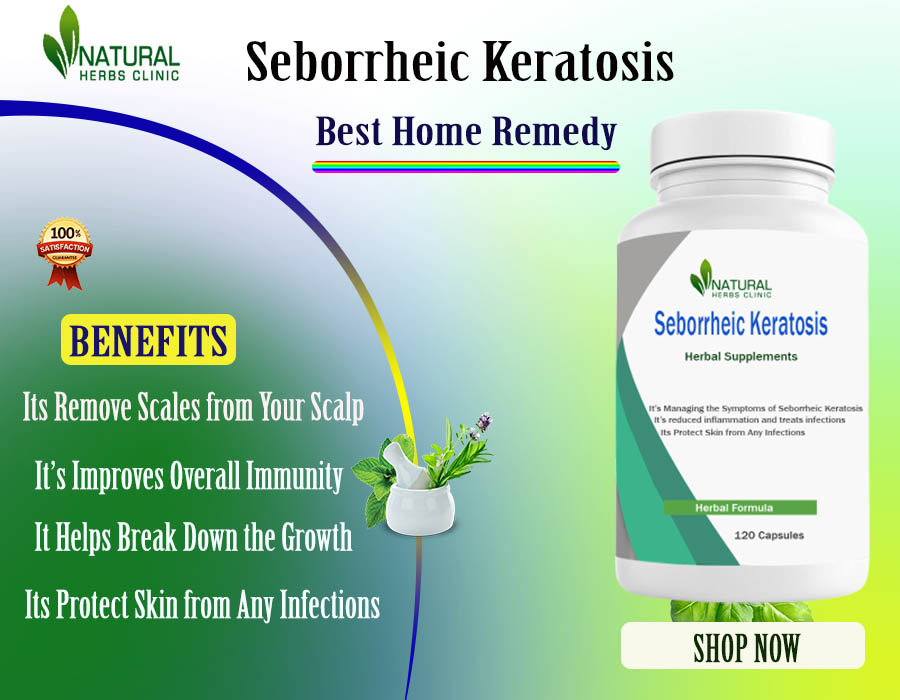 Get Natural Relief from Seborrheic Keratosis Using Home Remedies