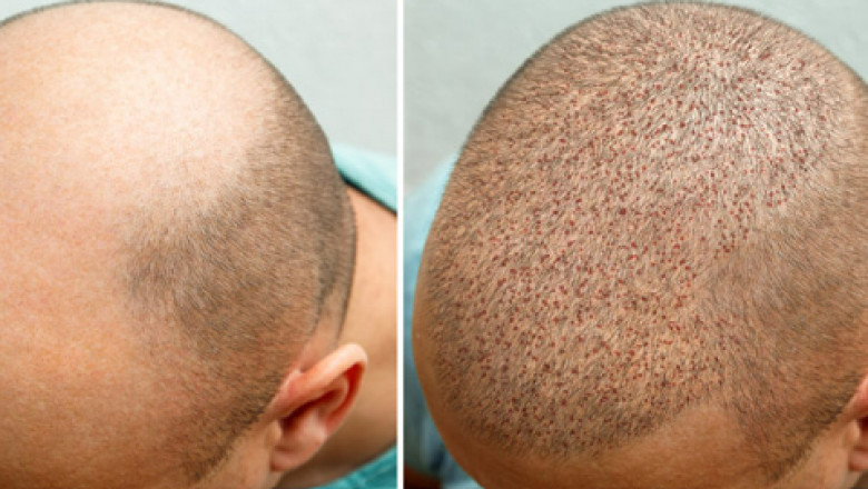 5 Qualities to Look for in India’s Best Hair Transplant Surgeon