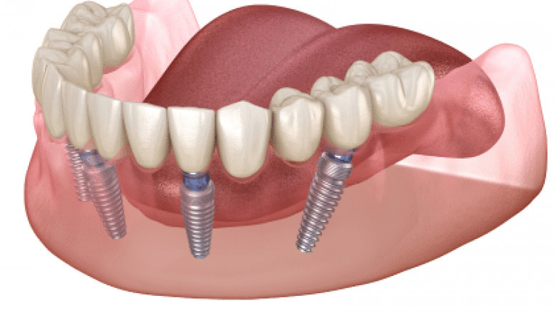How Ongoing Check-ups Help Preserve Dental Implants