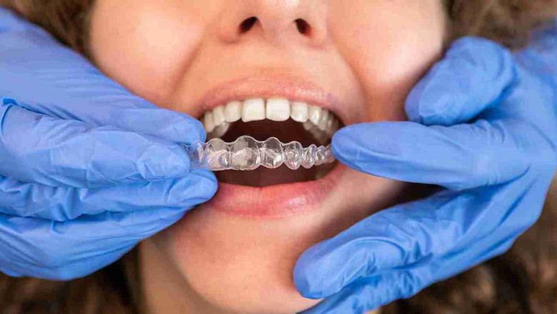 The Clear Alternative: Why Bury Chooses Invisalign