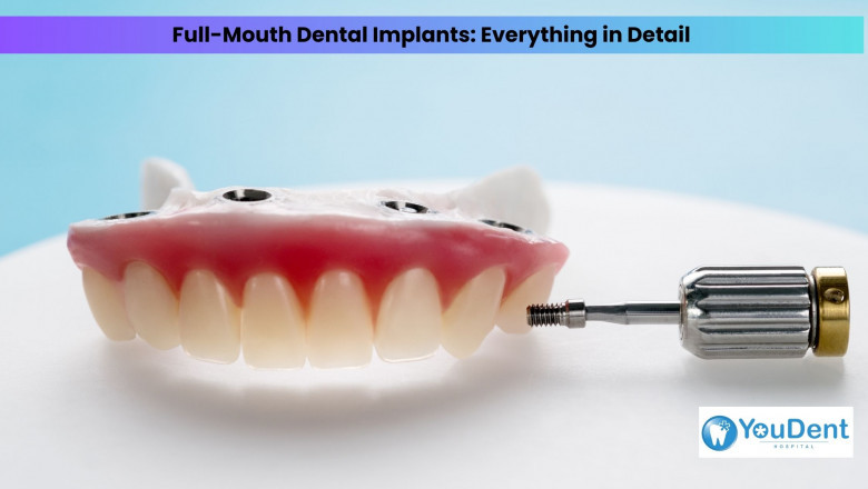 Full-Mouth Dental Implants: Everything in Detail