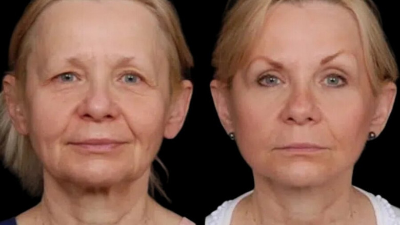 How Under Eye Fillers Treatment in Dubai Works for Various Skin Types
