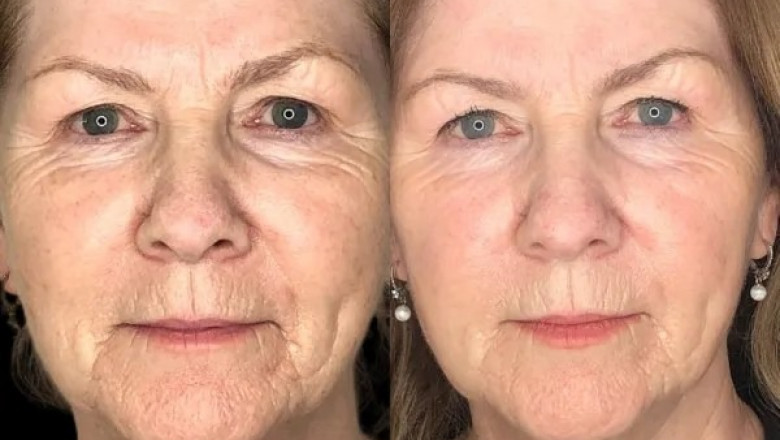 Experience Skin Harmony via Profhilo at Best Aesthetic Clinic in dubai