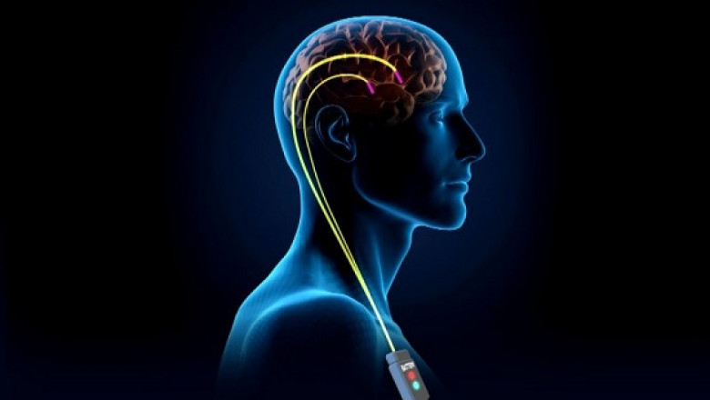 Deep Brain Stimulation Market: Growth, Trends, and Global Forecasts by 2031