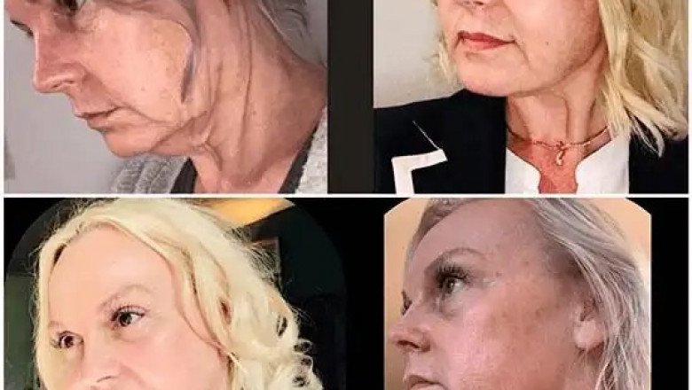 Restart Youthful Skin with Profhilo from Best Aesthetic Clinic in dubai
