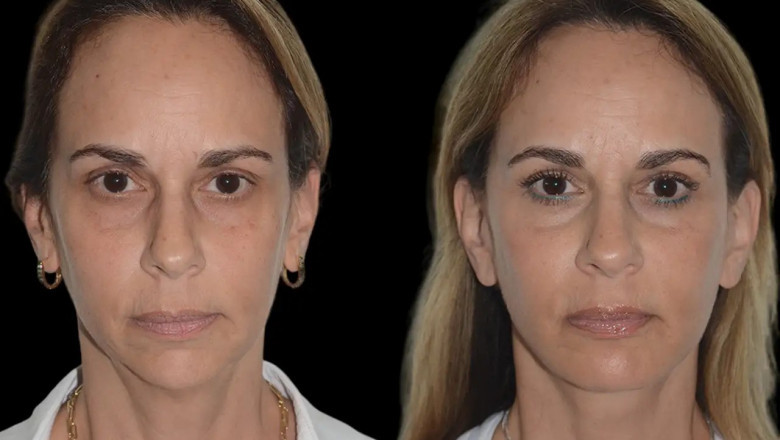 The Process of Getting Chin Fillers with the Best Plastic Surgeon in dubai