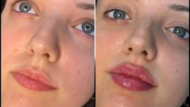 How to Achieve a Sculpted Jawline with the Best Plastic Surgeon in dubai for Fillers